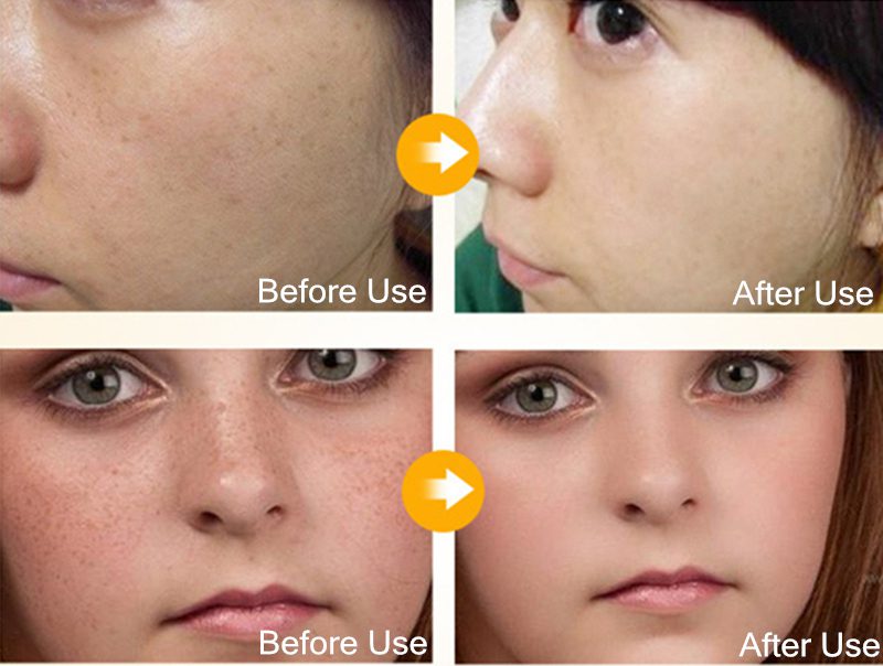 Dimollaure Kojic acid Whitening Cream Retinol Vitamin A serum Remove Freckle melasma pigment Melanin Acne scar dark Spots Dimollaure Kojic acid Whitening Cream Retinol Vitamin A serum Remove Freckle melasma pigment Melanin Acne scar dark Spots