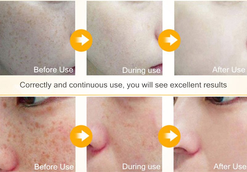 Dimollaure Kojic acid Whitening Cream Retinol Vitamin A serum Remove Freckle melasma pigment Melanin Acne scar dark Spots Dimollaure Kojic acid Whitening Cream Retinol Vitamin A serum Remove Freckle melasma pigment Melanin Acne scar dark Spots