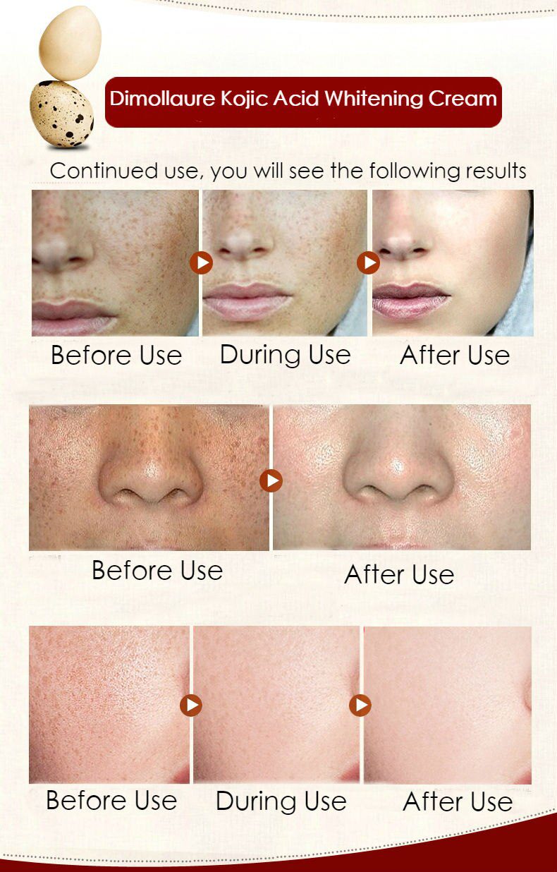 Dimollaure Kojic acid Whitening Cream Retinol Vitamin A serum Remove Freckle melasma pigment Melanin Acne scar dark Spots Dimollaure Kojic acid Whitening Cream Retinol Vitamin A serum Remove Freckle melasma pigment Melanin Acne scar dark Spots