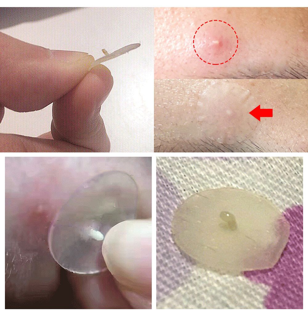 BREYLEE Acne Pimple Patch Face Mask Skin Care Acne Treatment Serum Face Cream Acne Cream Essence Sheet Mask Facial Care Tools BREYLEE Acne Pimple Patch Face Mask Skin Care Acne Treatment Serum Face Cream Acne Cream Essence Sheet Mask Facial Care Tools