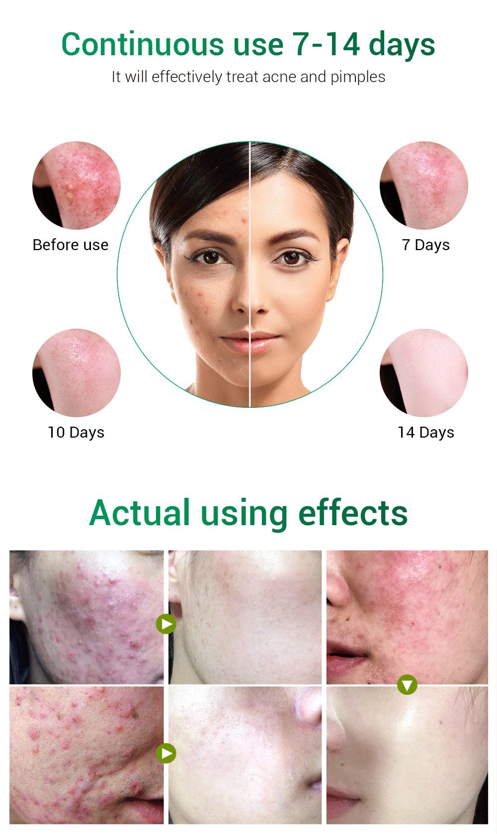 BREYLEE Acne Pimple Patch Face Mask Skin Care Acne Treatment Serum Face Cream Acne Cream Essence Sheet Mask Facial Care Tools BREYLEE Acne Pimple Patch Face Mask Skin Care Acne Treatment Serum Face Cream Acne Cream Essence Sheet Mask Facial Care Tools