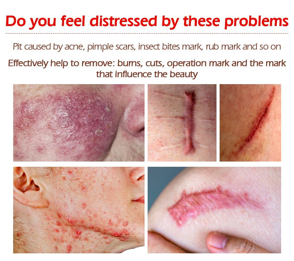 VIBRANT GLAMOUR Repair Scar Removal Cream Acne Scars Gel Stretch Marks Surgical Scar Burn For Body Pigmentation Corrector Care VIBRANT GLAMOUR Repair Scar Removal Cream Acne Scars Gel Stretch Marks Surgical Scar Burn For Body Pigmentation Corrector Care