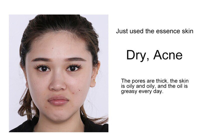 24K Gold Niacinamide Face Essence Moisturizing Anti-aging&Wrinkle Hyaluronic Acid Serum Shrinks Pores Repairs Dry Loose Skin 24K Gold Niacinamide Face Essence Moisturizing Anti-aging&Wrinkle Hyaluronic Acid Serum Shrinks Pores Repairs Dry Loose Skin