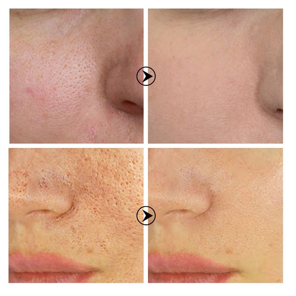 Salicylic Acid Shrink Pores Serum Fruit Acid Exfoliating Moisturizing Nourish Smooth Pores Repair Essence Products Skin Care Salicylic Acid Shrink Pores Serum Fruit Acid Exfoliating Moisturizing Nourish Smooth Pores Repair Essence Products Skin Care
