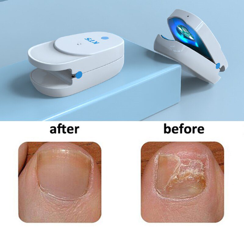 Fungal Nail Treatment Laser Device For Nail Fungus 905nm 470nm Fungus Nail Removal Anti Infection Paronychia Onychomycosis Care Fungal Nail Treatment Laser Device For Nail Fungus 905nm 470nm Fungus Nail Removal Anti Infection Paronychia Onychomycosis Care