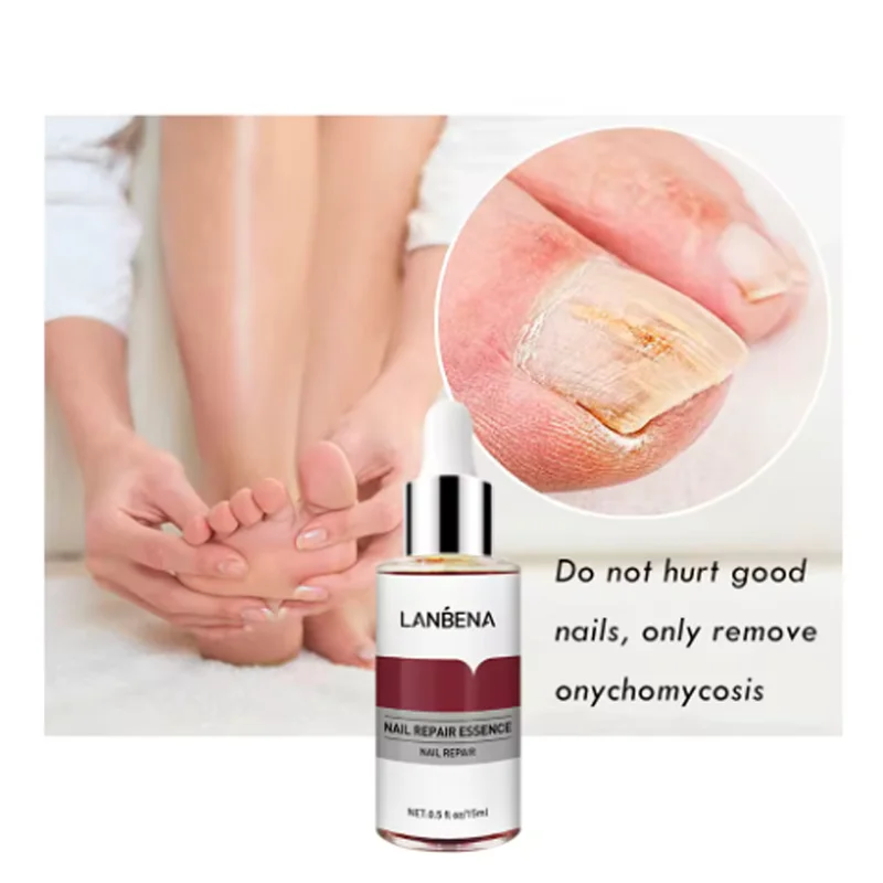 LANBENA Fungus Care Remove Onychomycosis Toes Nourish Brighten Hands Feet Product Repair Suitable Women Nail Pepair Essencs LANBENA Fungus Care Remove Onychomycosis Toes Nourish Brighten Hands Feet Product Repair Suitable Women Nail Pepair Essencs
